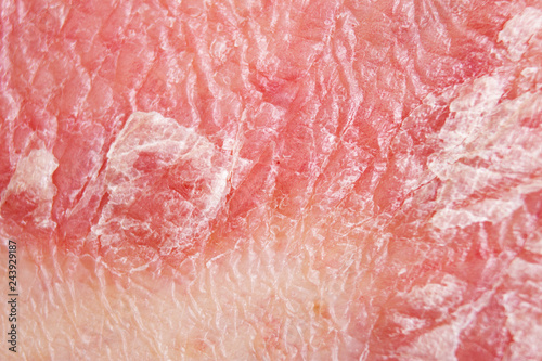 Detail of psoriatic skin disease Psoriasis Vulgaris with narrow focus, skin patches are typically red, itchy, and scaly