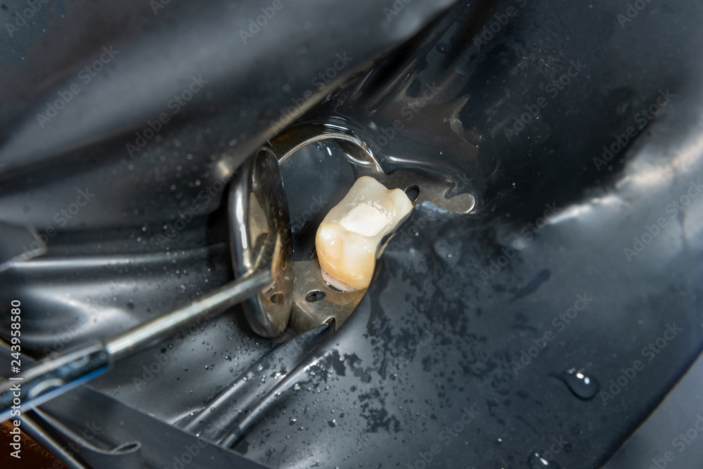 two chewing side teeth of the upper jaw after treatment of caries