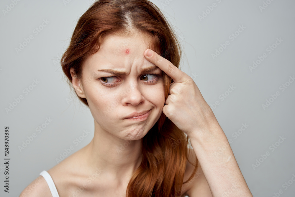 woman with acne on the forehead woman with acne on the forehead