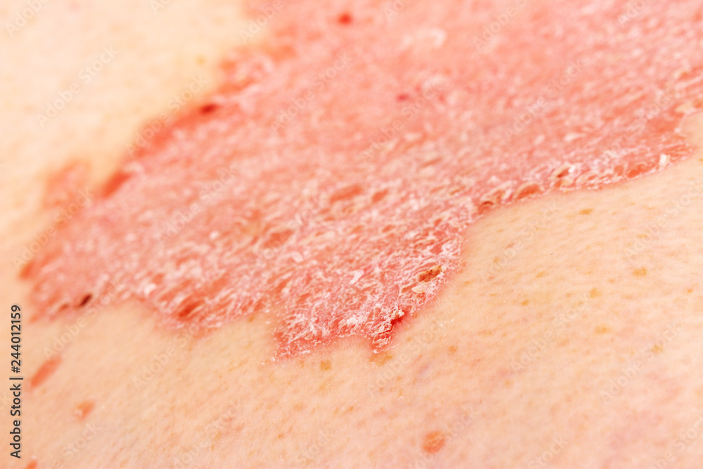 Detail of psoriatic skin disease Psoriasis Vulgaris with narrow focus, skin patches typically red itchy and scaly Detail of psoriatic skin disease Psoriasis Vulgaris with narrow focus, skin patches typically red itchy and scaly