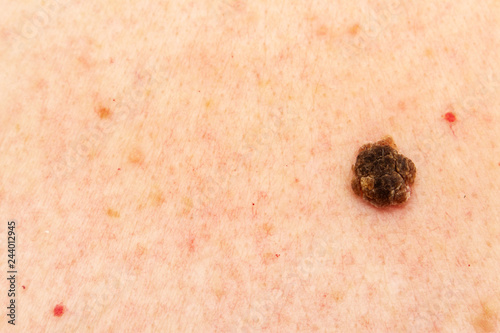 Seborrheic keratosis also known as seborrheic verruca or a senile wart, narrow focus and copy space