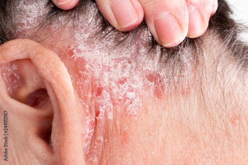 Detail of psoriatic skin disease Psoriasis Vulgaris in hair and ear with narrow focus, skin patches typically red itchy and scaly photo