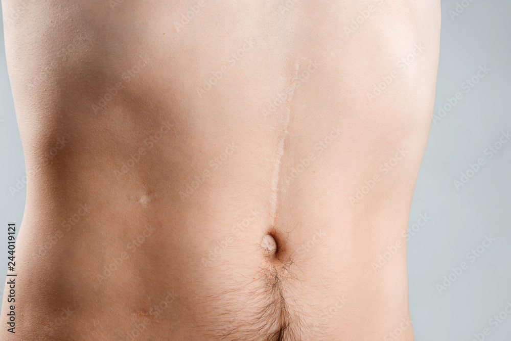 scars removal concept, large scar after surgery on the abdomen young man, blurred neutral background, selective focus scars removal concept, large scar after surgery on the abdomen young man, blurred neutral background, selective focus