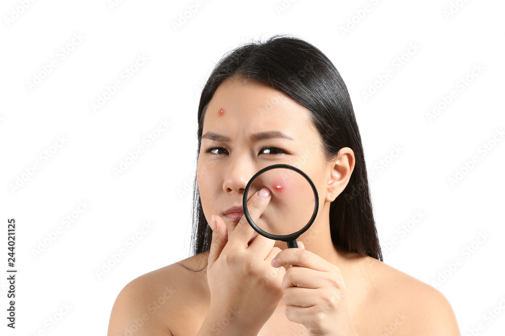 Portrait of young Asian woman with acne problem and magnifier on white background Portrait of young Asian woman with acne problem and magnifier on white background