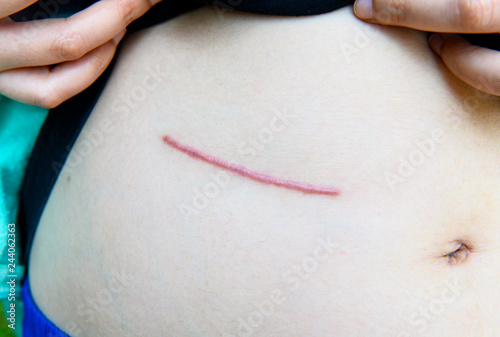 Closeup of woman showing on your stomach with a scar