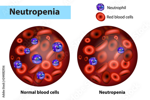 Neutropenia or neutropaenia and Normal blood cells. 