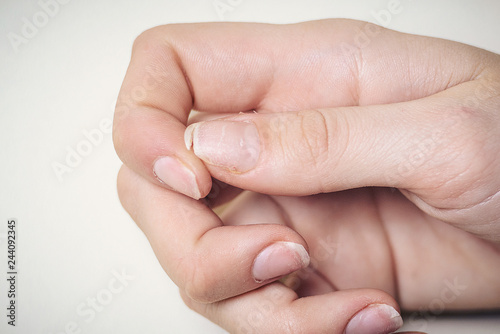 Close-up of brittle nails. A broken nail on your finger. photo