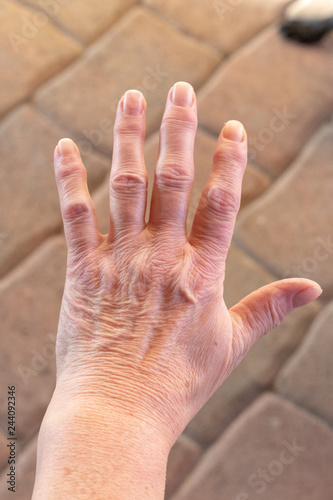 These are hands of a old woman with finger pain