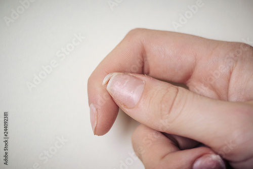 Close-up of brittle nails. A broken nail on your finger.