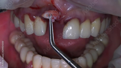 adding soft tissue to the gingival cavity and suturing tissue for recovery and aesthetics