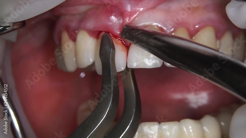 removal of the front tooth with carbonic root