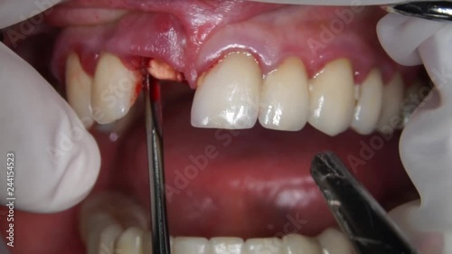 removal of residual root of anterior tooth in dental surgery