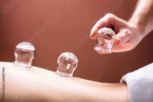 Therapist Placing Glass Cups On Woman's Back