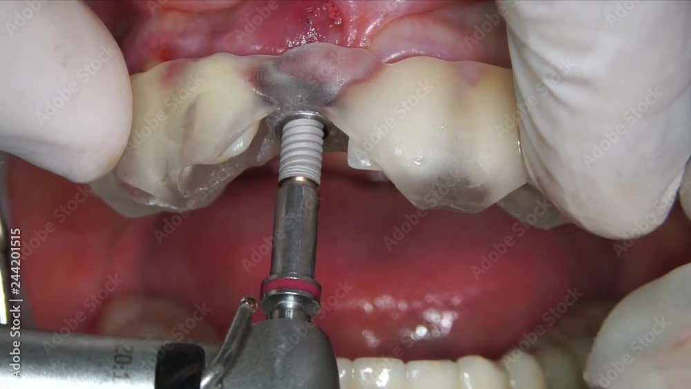 drilling with long surgical bits.before dental implantation