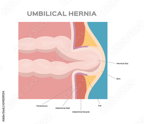 umbilical hernia / intestine / human anatomy / belly vector