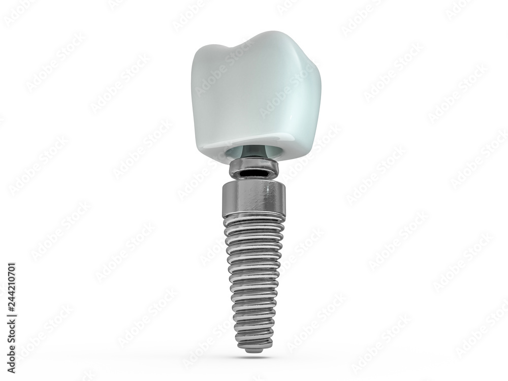 Dental implant dentist, tooth layout, plastics, man, teeth, treatment. 3D Dental implant dentist, tooth layout, plastics, man, teeth, treatment. 3D