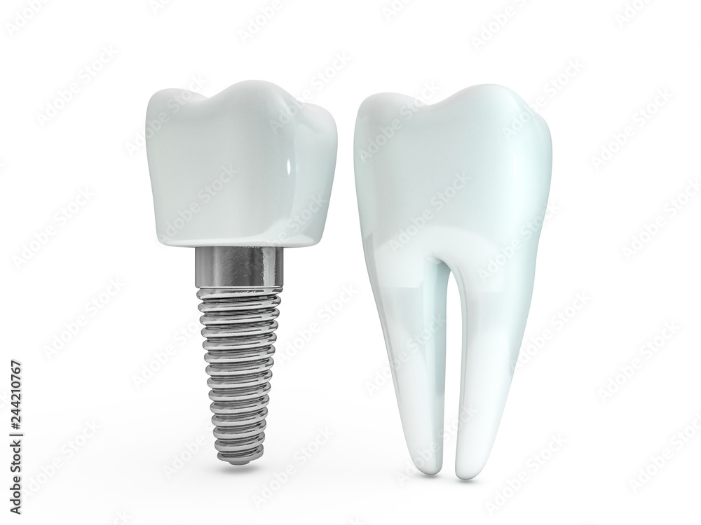 Dental implant dentist, tooth layout, plastics, man, teeth, treatment. 3D Dental implant dentist, tooth layout, plastics, man, teeth, treatment. 3D