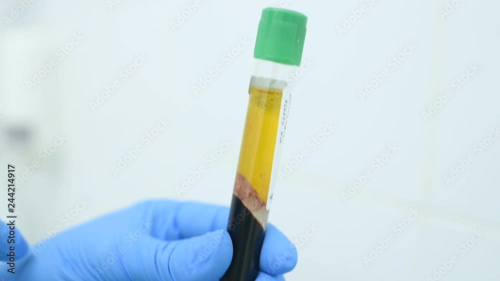 plasma extraction from the patient's blood for the procedure of plasmolifting-skin rejuvenation.