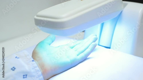 hands of a patient with psoriasis close-up under an ultraviolet lamp. Light therapy, phototherapy