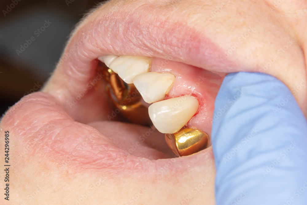 two chewing side teeth of the upper jaw after treatment of caries