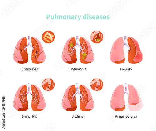 Pulmonary disease vector