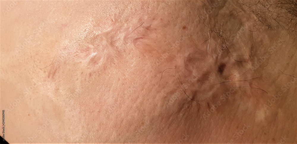 Fototapeta premium Burns on the human body.Scar from burns on the body. Wounds on the body.