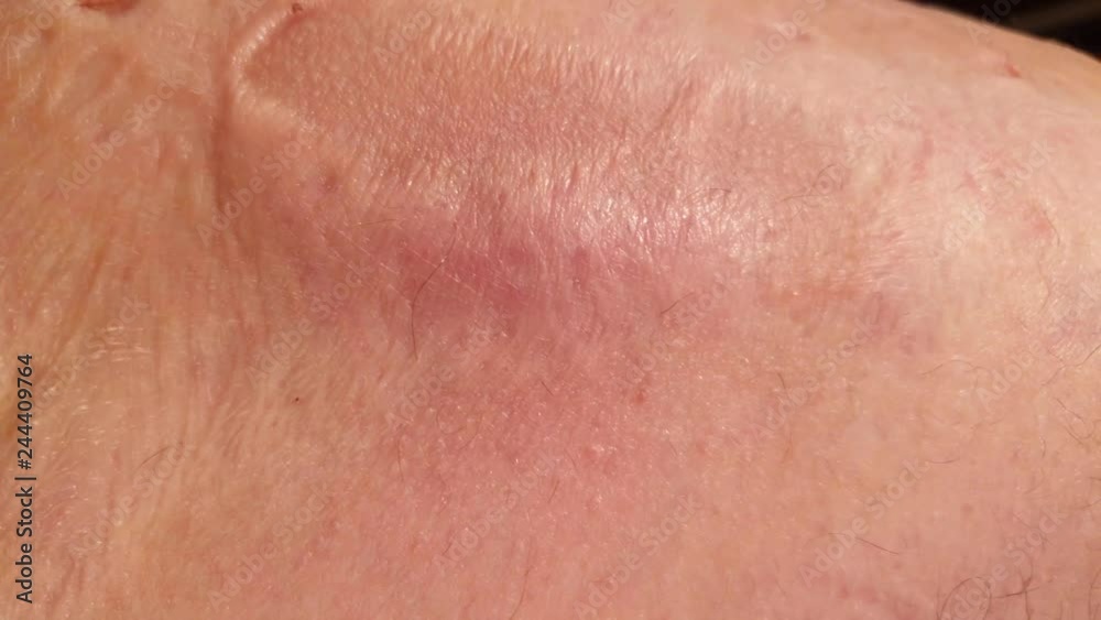 Burns on the human body.Scar from burns on the body. Wounds on the body. Burns on the human body.Scar from burns on the body. Wounds on the body.