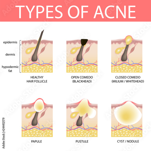 Medical vector illustration of different types of acne on human skin. Appearance of pimples in hair follicle.