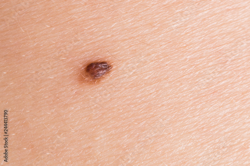 Foto Abnormal mole
