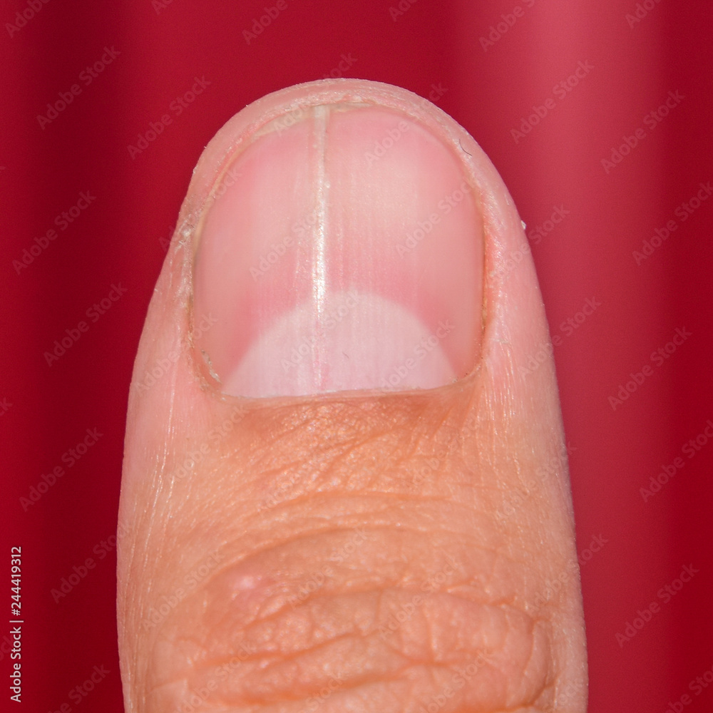 Forked nail on the thumb. Dilation of the nail, traumatic pathol Forked nail on the thumb. Dilation of the nail, traumatic pathol