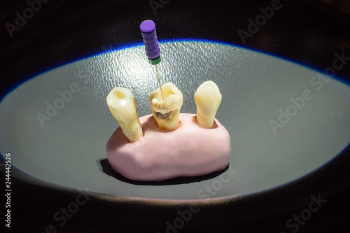 Caries in the tooth. Removi...