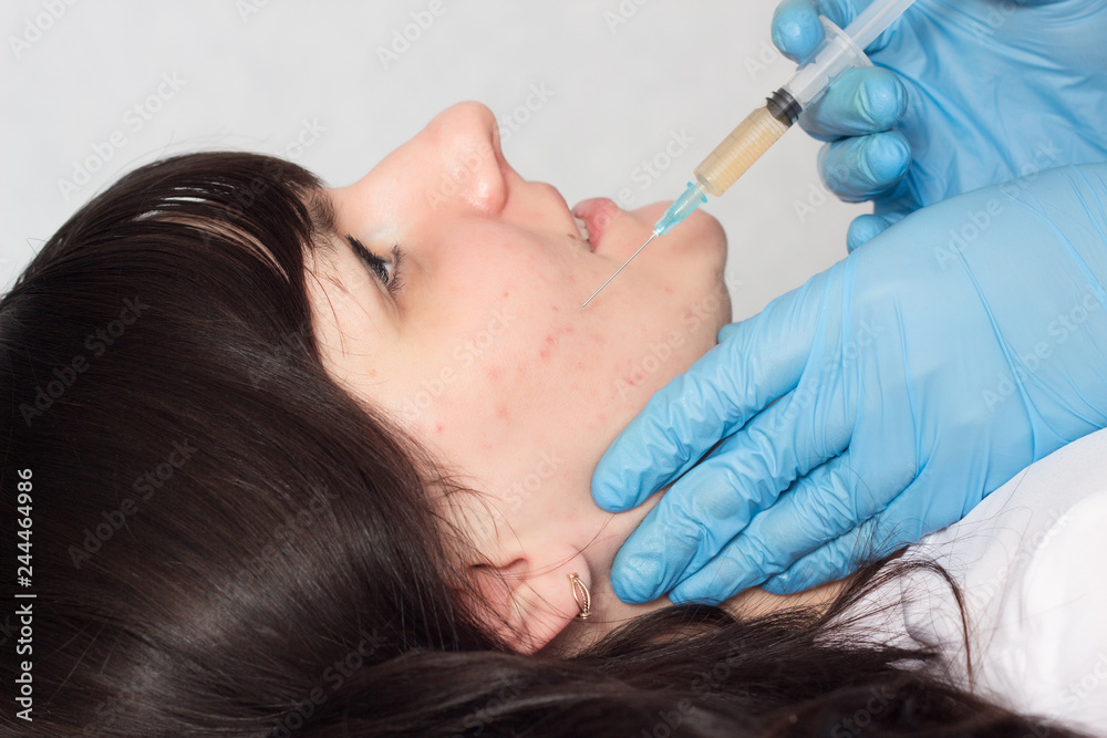 A cosmetologist does a plasma-lifting procedure for a young girl against acne on her face, plasma therapy in cosmetology A cosmetologist does a plasma-lifting procedure for a young girl against acne on her face, plasma therapy in cosmetology