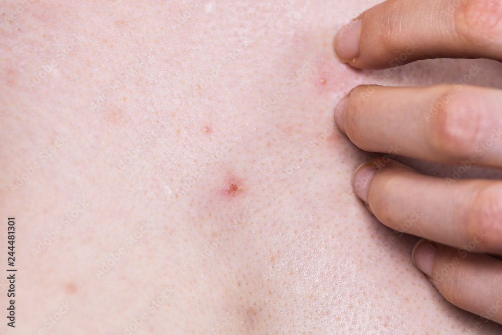 Woman dealing with pimples red spots Woman dealing with pimples red spots