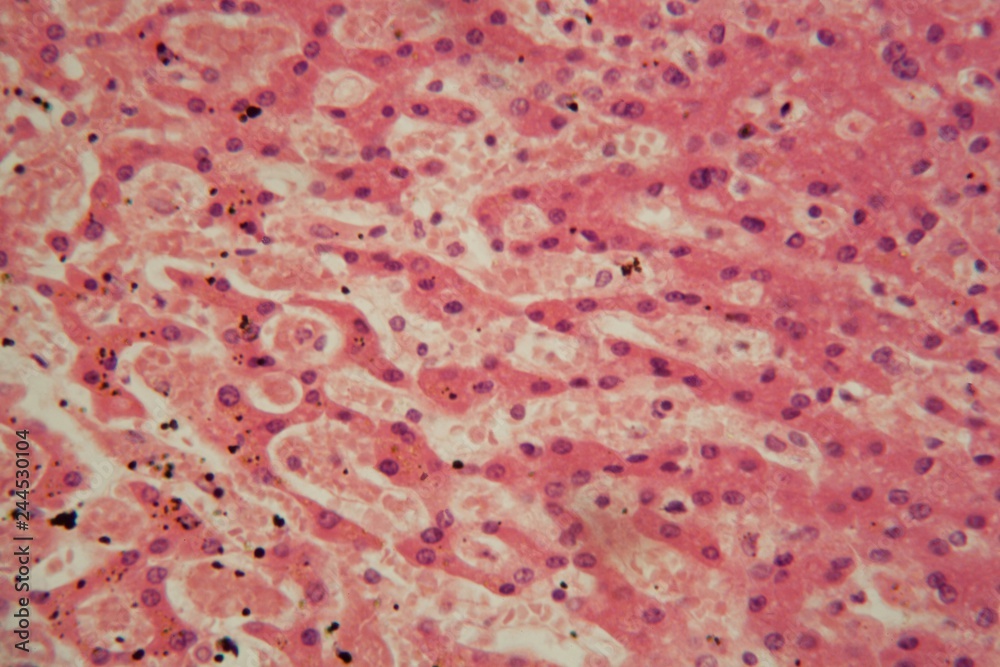 Human liver cells with tuberculosis under the microscope. Human liver cells with tuberculosis under the microscope.