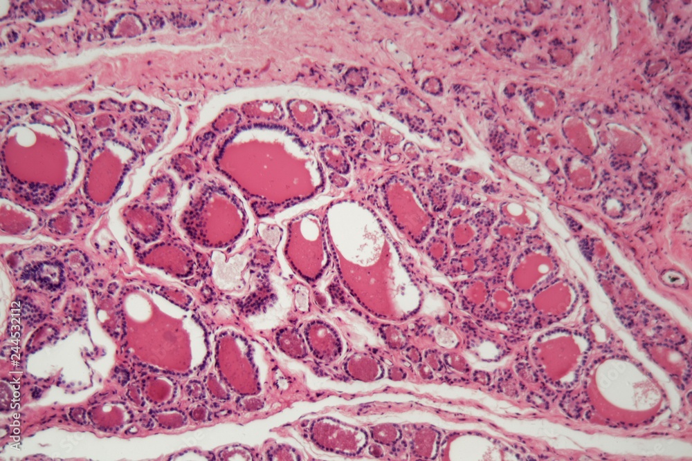 Cells of a human thyroid gland with swelling under a microscope. Cells of a human thyroid gland with swelling under a microscope.
