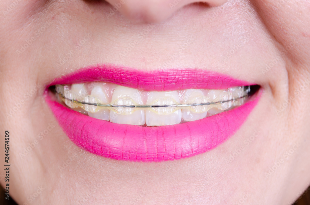 Fototapeta premium Teeth with sapphire braces and a smile of a young woman with painted lips.