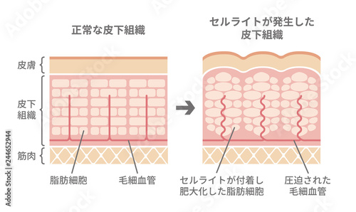 健康な皮膚とセルライトが発生した皮膚の断面比較イラスト