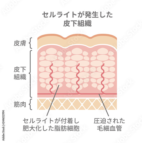 セルライトが発生した皮膚の断面図イラスト