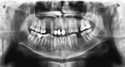Panoramic radiograph is a panoramic scanning dental X-ray of the upper and lower jaw. This is a focal plane tomography shows the maxilla and mandible of a forty year old man.
