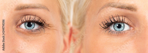 wrinkles cosmetic treatment, images composition showing results before and after crow's feet removal photo