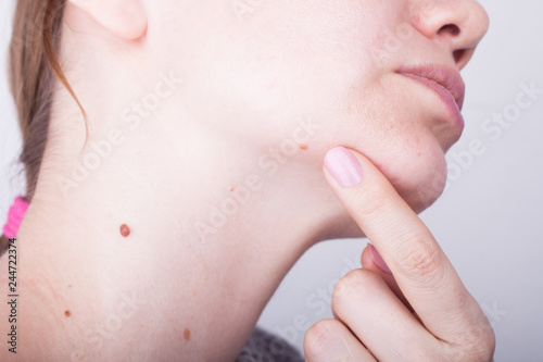 Girl with birthmarks on the neck