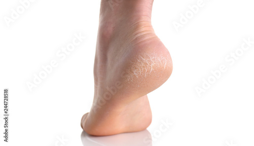 The heel of foot with bad skin covered with cracks