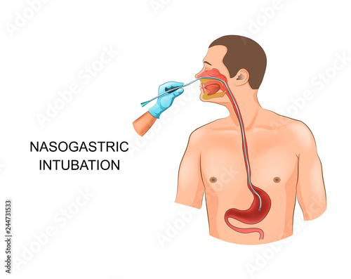 nasogastric tube in the stomach photo