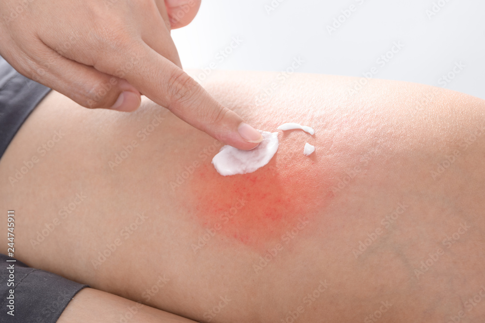 Scratch Allergic skin from mosquito or insect bites and apply medicine cream,Healthcare And Medicine concpet Scratch Allergic skin from mosquito or insect bites and apply medicine cream,Healthcare And Medicine concpet