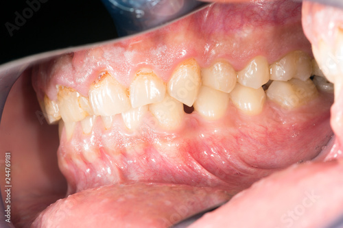Side View Of Human Jaw With Overbite Dental Occlusion Closeup