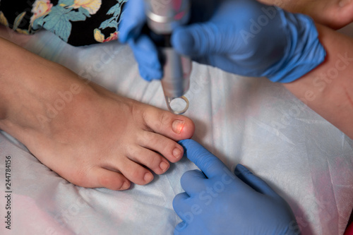 Toenail fungus treatment with foot laser at laser nail therapy clinic. - Image