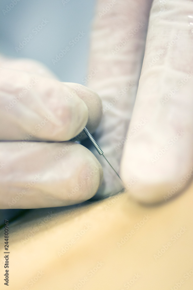 Obraz premium Dry needling EPI needle