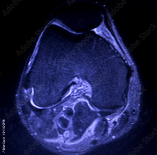 Photography MRI knee meniscus tear scan
