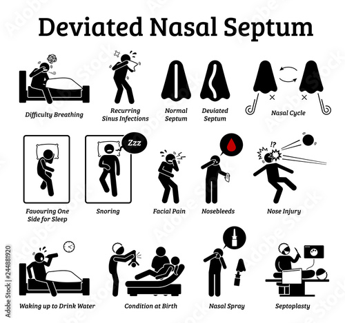 Deviated nasal septum icons. Illustrations depict signs and symptoms of nose problem. Difficulty breathing, sinus infection, snoring, and facial pain. Treatments are nasal spray and septoplasty.