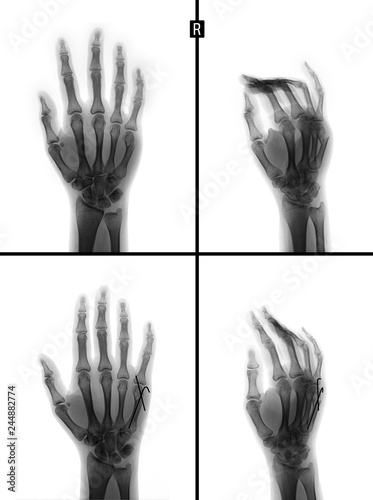 X-ray of the hand. Fracture of the 5rd metacarpal bone. Reposition. Osteosynthesis. Negative. photo